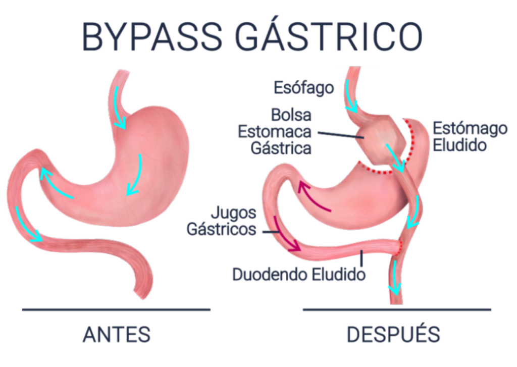 Gastric Bypass Vs Manga Gastric Image